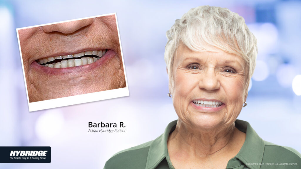 Older woman smiling before and after Hybridge treatment