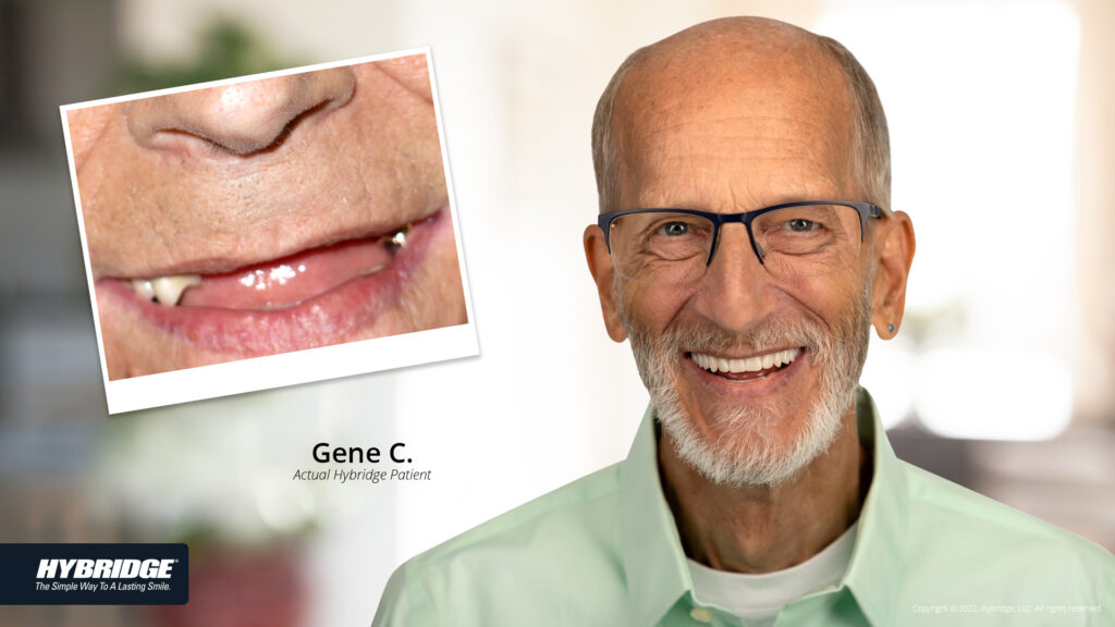 Older man smiling before and after Hybridge treatment