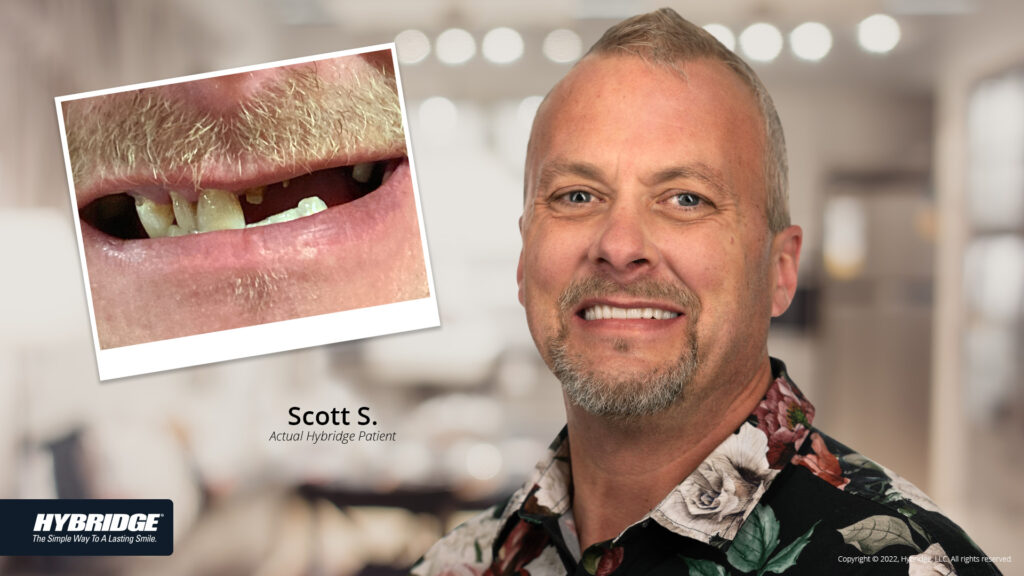 Man smiling before and after Hybridge treatment.